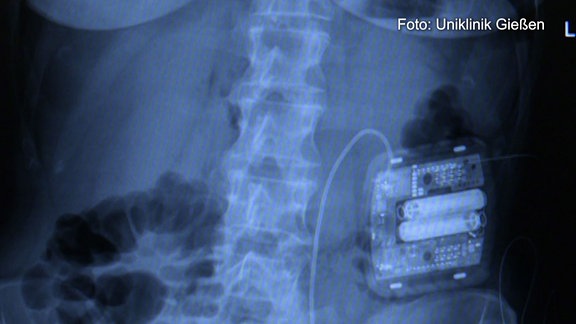 Röntgenaufnahme von Unterleib mit Neurostimulator