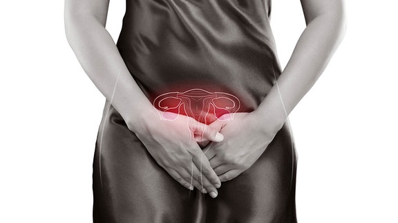 Endometriose