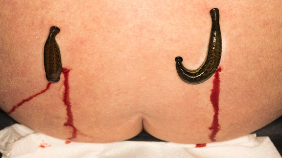 Zwei Medizinische Blutegel (Hirudo medicinalis) wurden links und rechts der Wirbelsäule angesetzt, Blut läuft am Gesäß herunter.