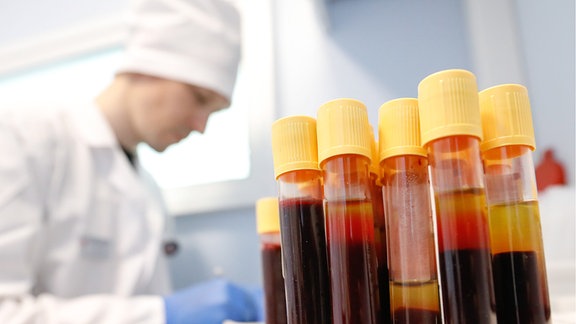 Blutproben von Menschen, die einen HIV-Test gemacht haben.