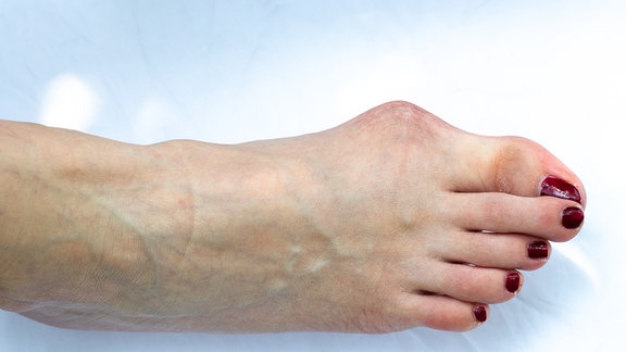 hallux, valgus, 