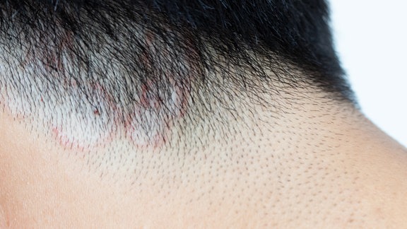Nahaufnahme von Ringelflechte (Tinea) auf dem Kopf