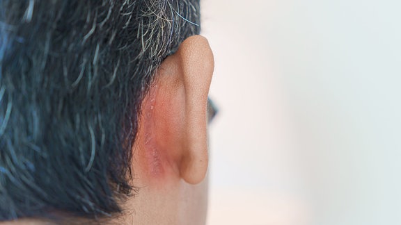 Mann hat Ohrenprobleme aufgrund von seborrhoischer Dermatitis