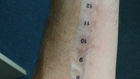 Allergietest am Unterarm