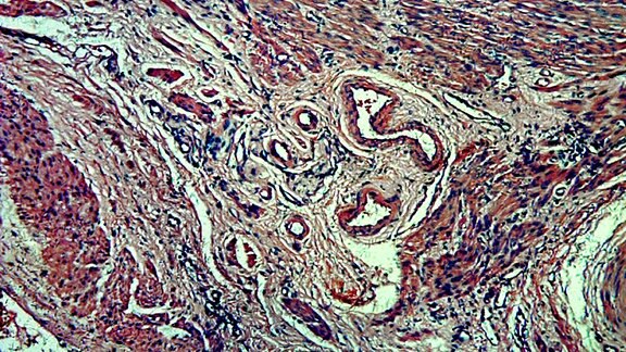 Histologischer Schnitt durch das Gewebe einer Gebärmutter mit Myom