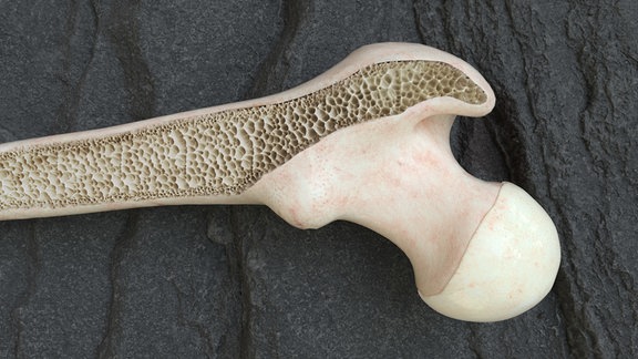 Ein Knochenmodell im Querschnitt mit Osteoporose.