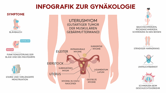 Infografik zu Unterleibskrebs