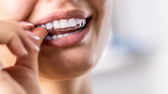 Eine Frau positioniert eine durchsichtige Zahnschiene auf ihren Zähnen.